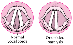 Vocal cord paralysis