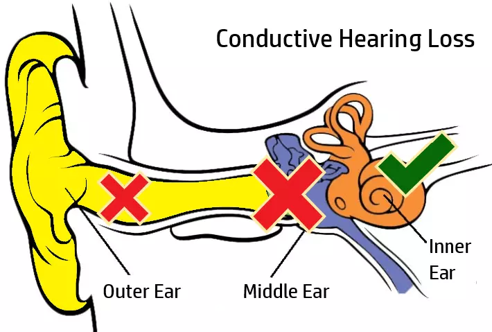 conductive-hearing-loss