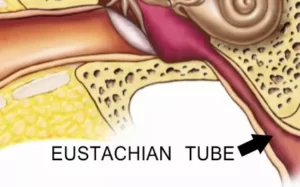 What Is Eustachian Tube Dysfunction