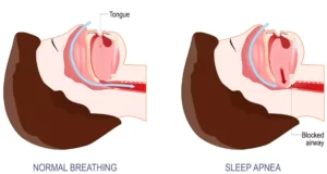 sleep apnea