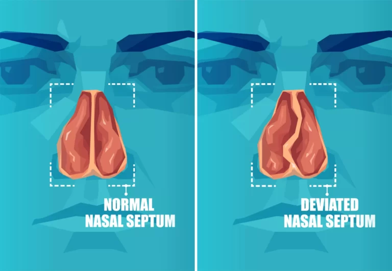 deviated-nasal-septum