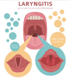 laryngitis