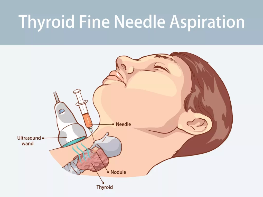 Thyroid Nodule
