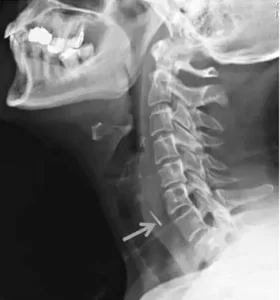 foreign-body-in-throat-Xray