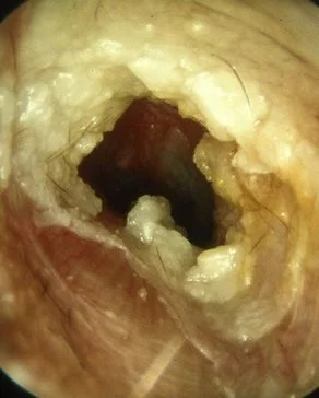 otitis externa