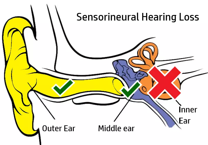 sensorineural-hearing-loss