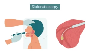 sialendoscopy