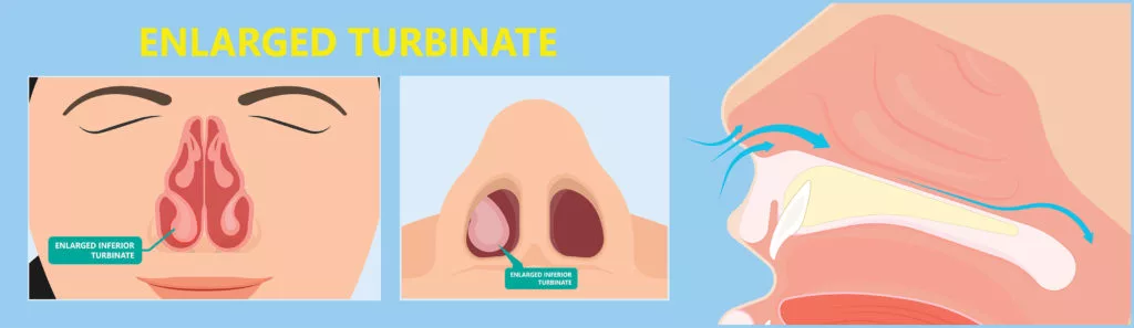 inferior-turbinate-hypertrophy