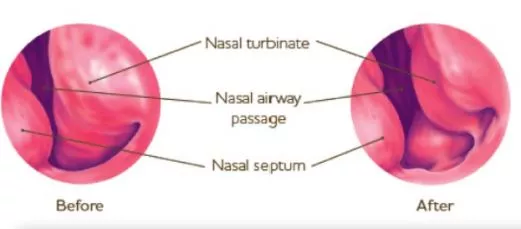 inferior-turbinate-reduction