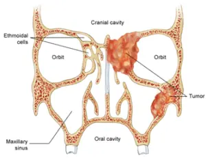 sinus-doctor-singapore-nasal-tumor