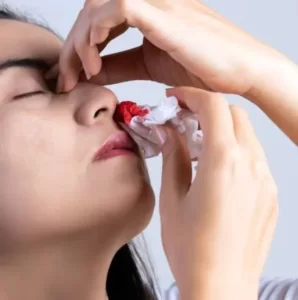 sinus-specialist-singapore-epistaxis