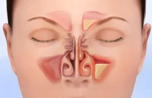 sinus-specialist-sinusitis