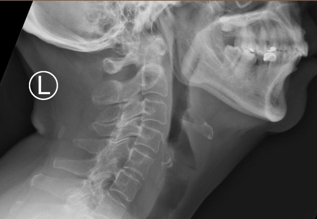 A Fish Bone Stuck In Throat What To Do? Dr Leslie Koh