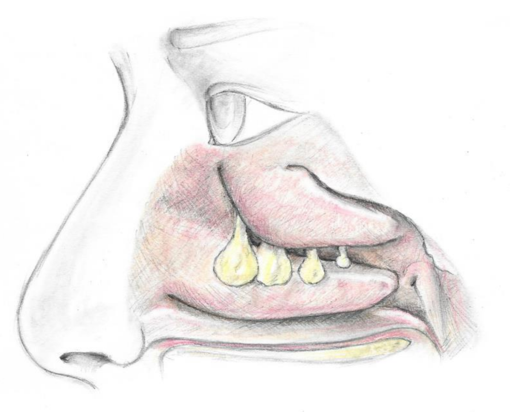 Nasal_polyps