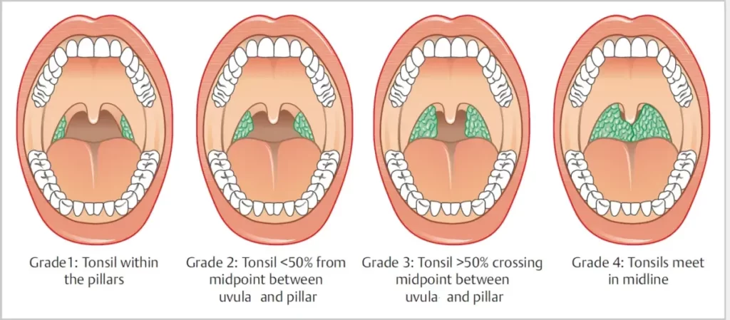 tonsillitis grading