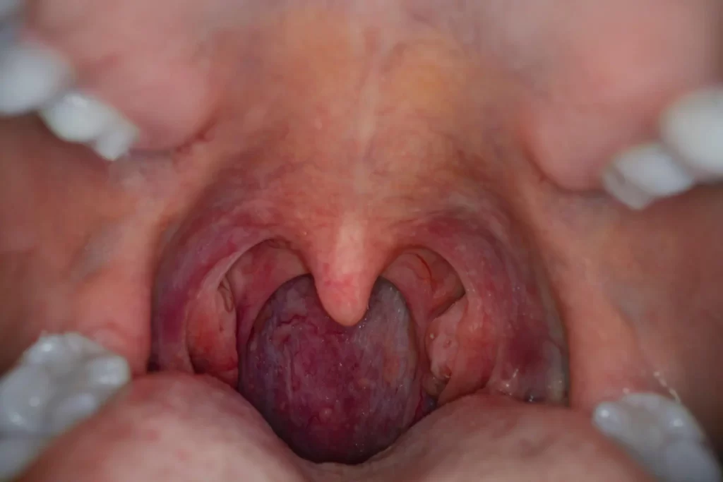 Tonsils