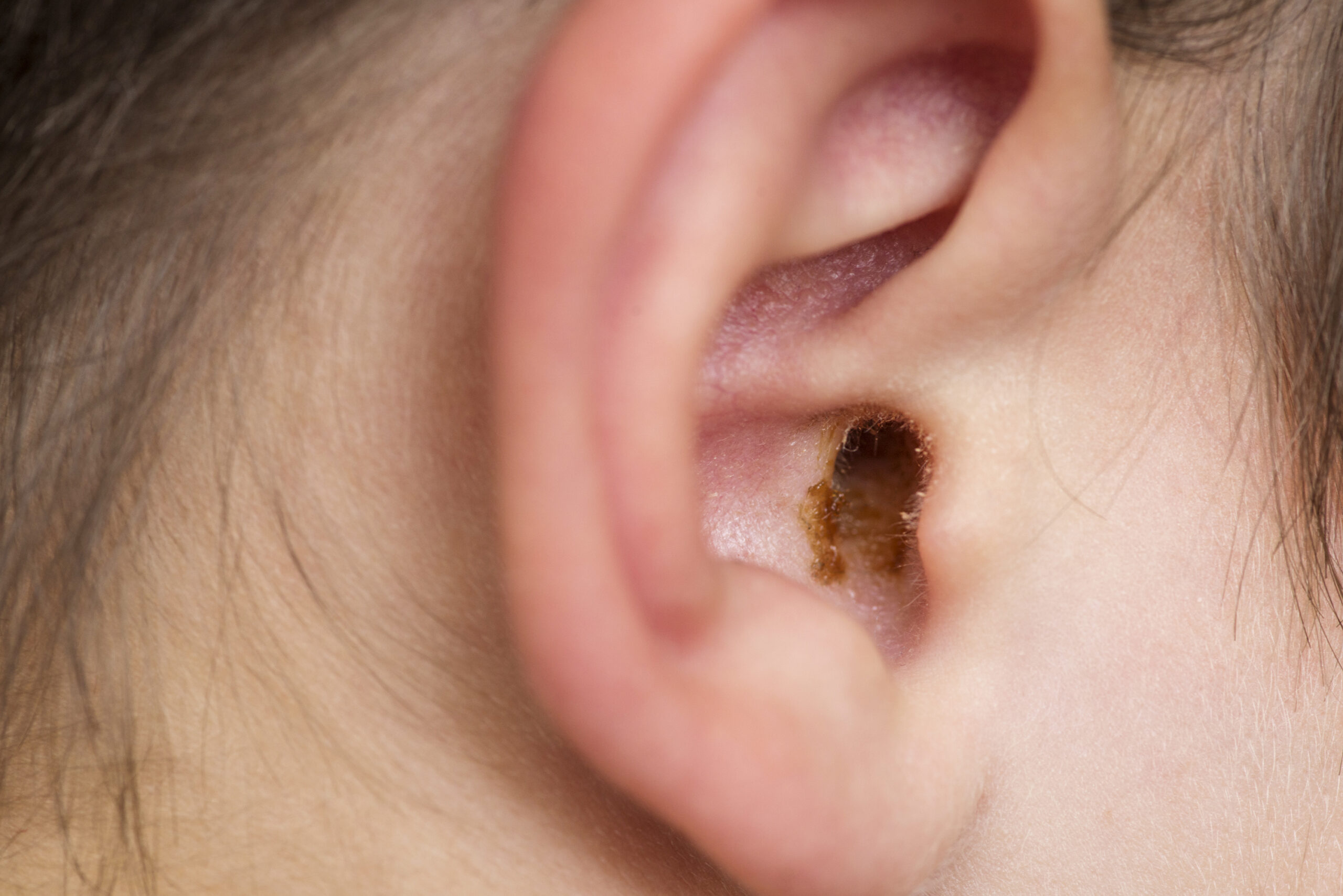 Earwax in the dirty ear of child. Hole ear of human, wax on hair and skin of ear