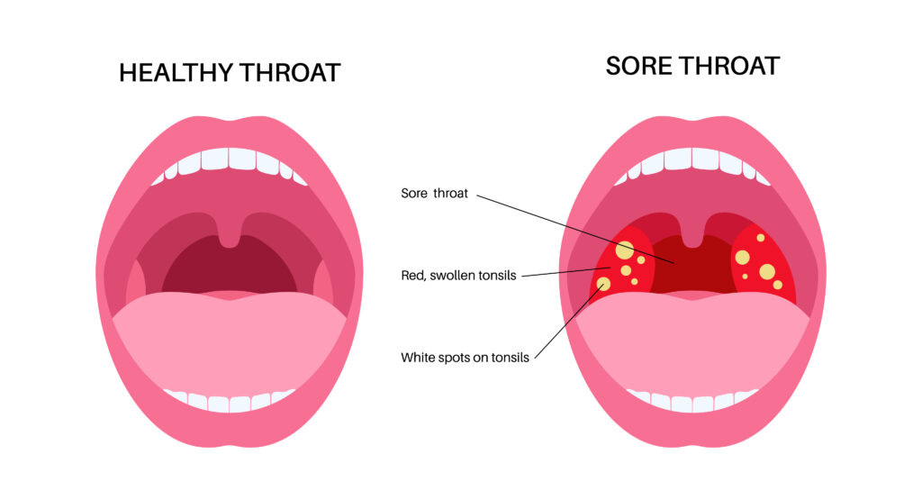 Image showing the symptoms of sore throat